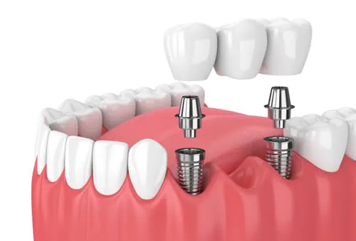 all on 6 dental implants dental implant bridge