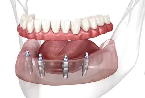 all on 6 dental implants fixed arch all on 4