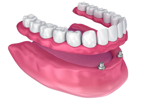 implant-supported-bridge snap on denture
